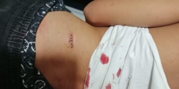 Ditebas Sesama Teman SMAN Labuhan Haji, Pelajar Lotim Dilarikan ke Puskesmas